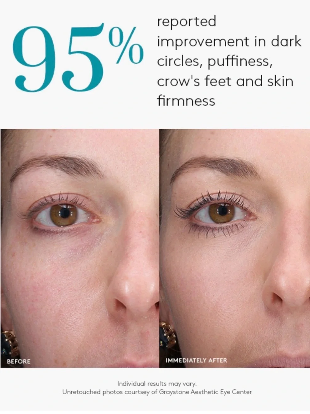 Total Eye 3-in-1 Renewal Therapy SPF 35 – White